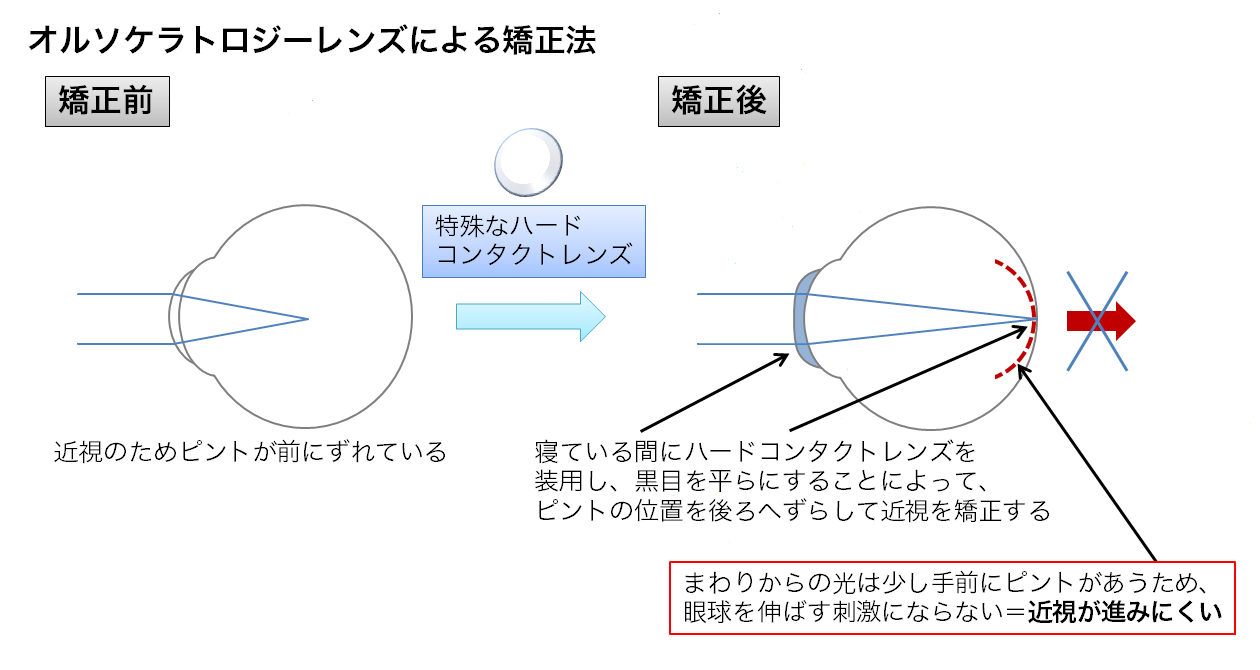 オルソケラトロジーレンズによる矯正法