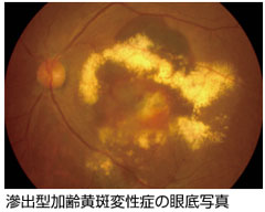 加齢性黄斑変性症の眼底写真