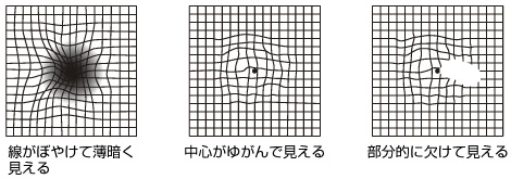 線がぼやけて薄暗く見える　中心がゆがんで見える　部分的に欠けて見える