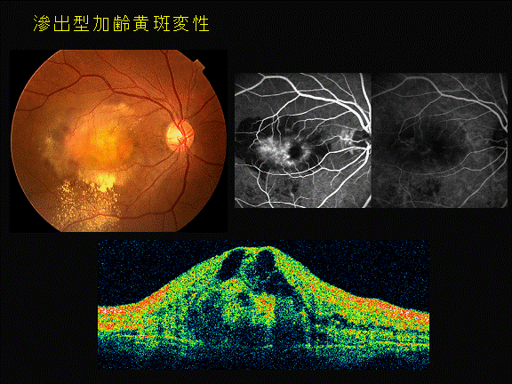 蛍光眼底造影検査 、OCＴ（三次元光断層計、断層撮影検査）