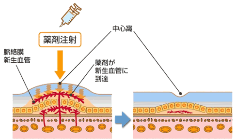 加齢黄斑変性症の治療