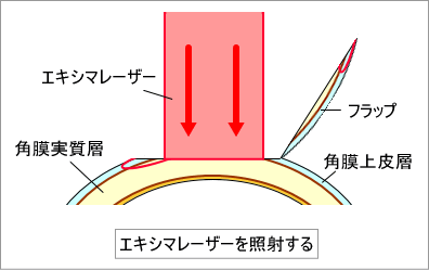 エキシマレーザーを照射する