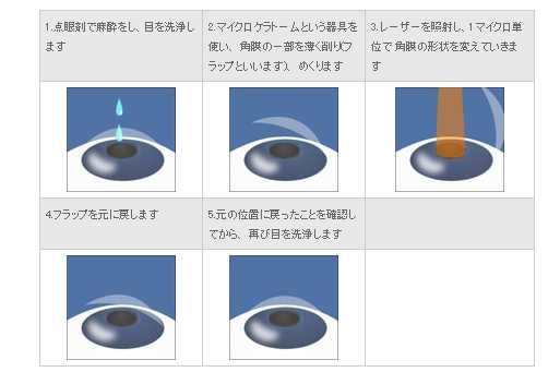 レーシック手術の流れ