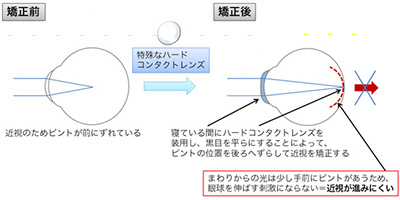 オルソケラソロジー／オルソレンズは子供の近視進行を予防します