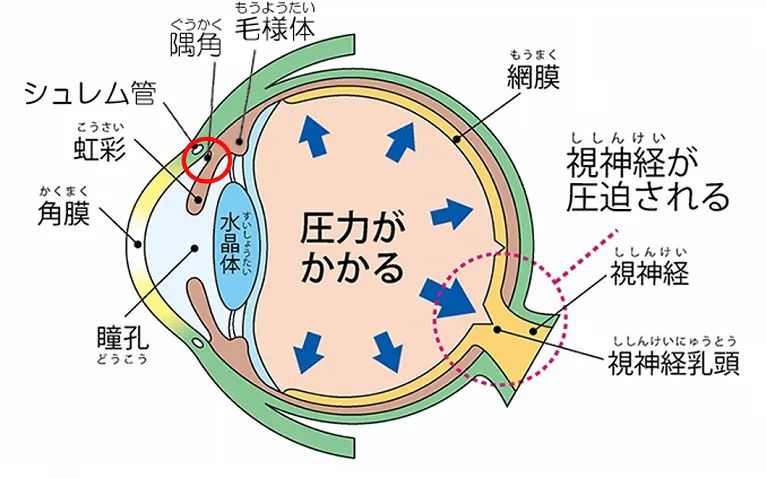 眼の解剖図：緑内障の仕組み