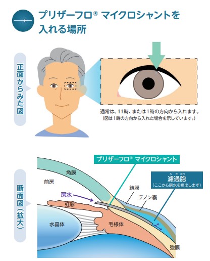 緑内障の視野進行段階
